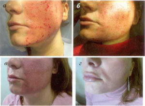stages of skin repair after fractional ablation procedure