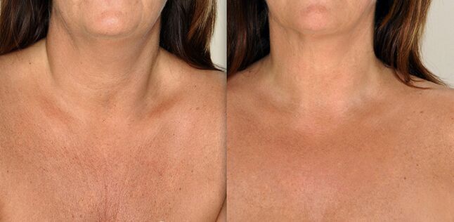 Neckline area before and after rejuvenation procedures