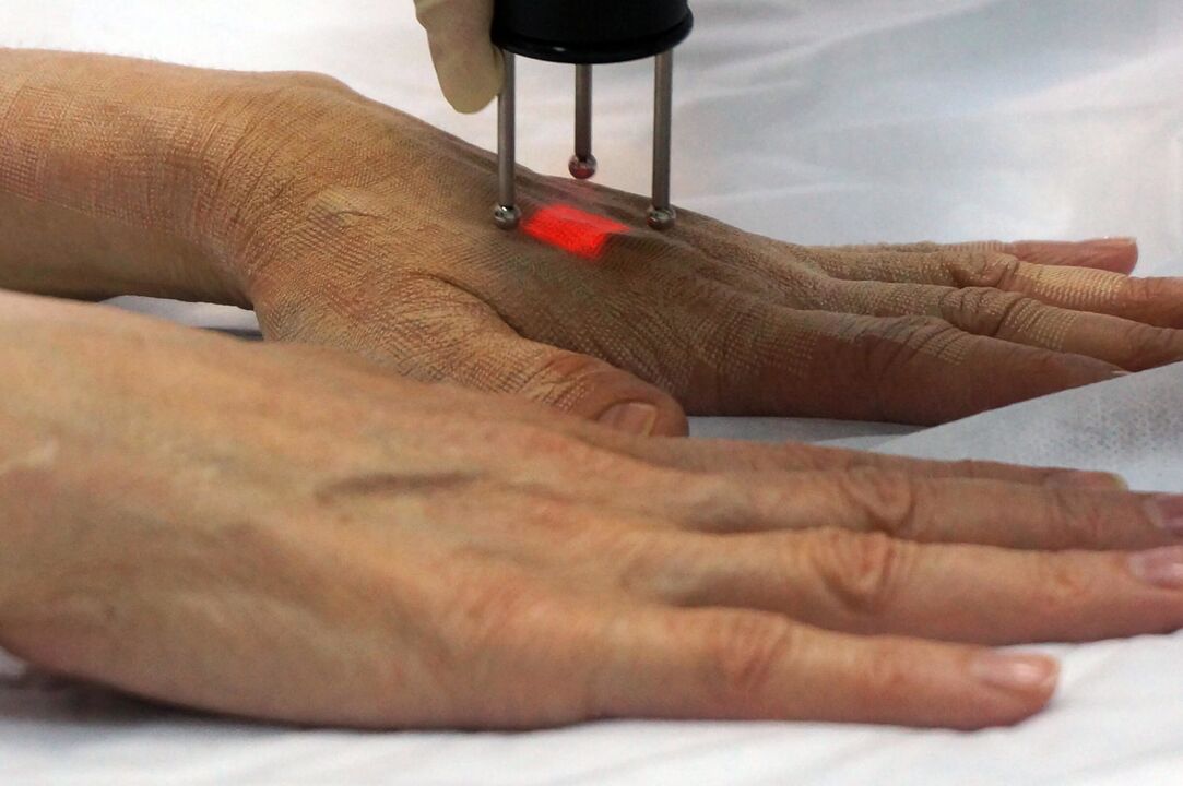 Laser rejuvenation of the hand by non-ablative methods