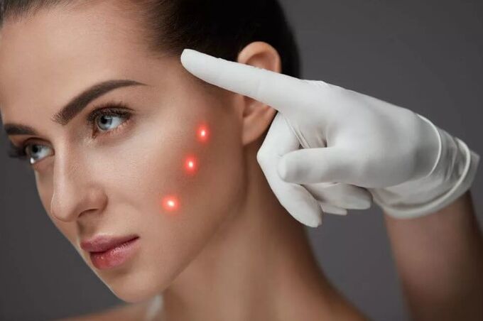 Laser renewal of the skin