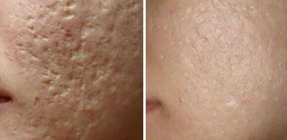 Scars laser grinding