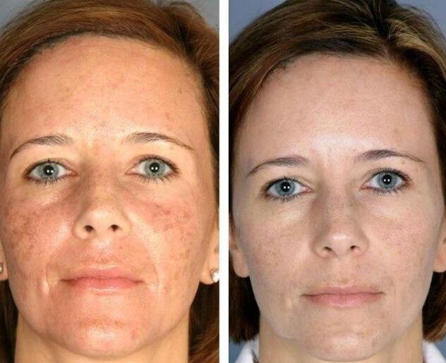 Laser rejuvenation