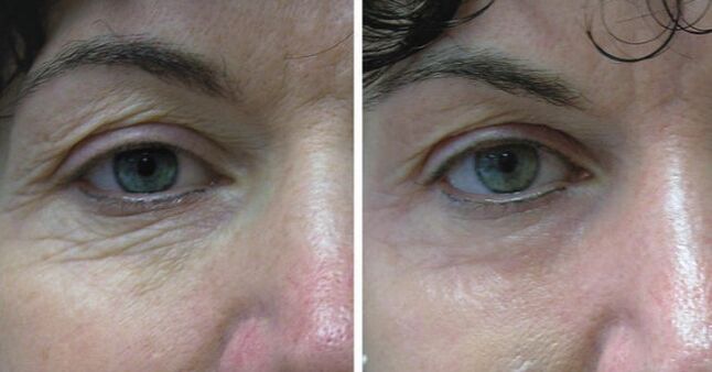 Leather laser around the eyes