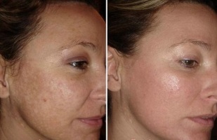 facial skin laser rejuvenation before and after photos